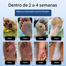 DiabeHeal™ Creme de Cicatrização da Pele para Diabéticos