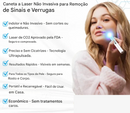 (Compre 1 LEVE 2)🔥 Caneta a Laser LOVILDS™ para Remoção de Sinais e Verrugas Sem Cirurgia ✅