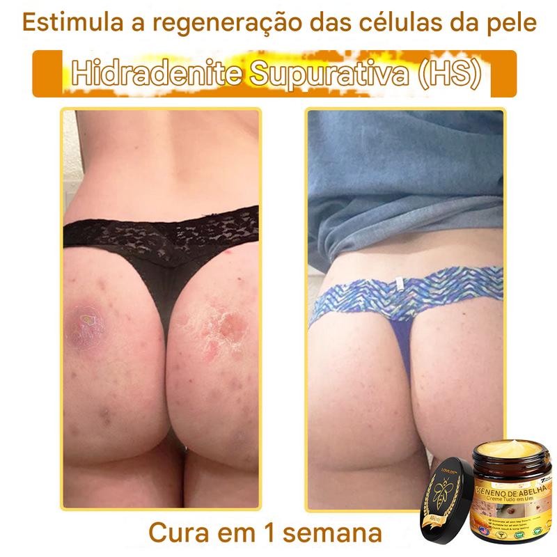(Compre 1 Leve 2)🔥 LOVILDS™ Creme Multifuncional com Veneno de Abelha 👩‍⚕️Aprovado por Dermatologistas ✅