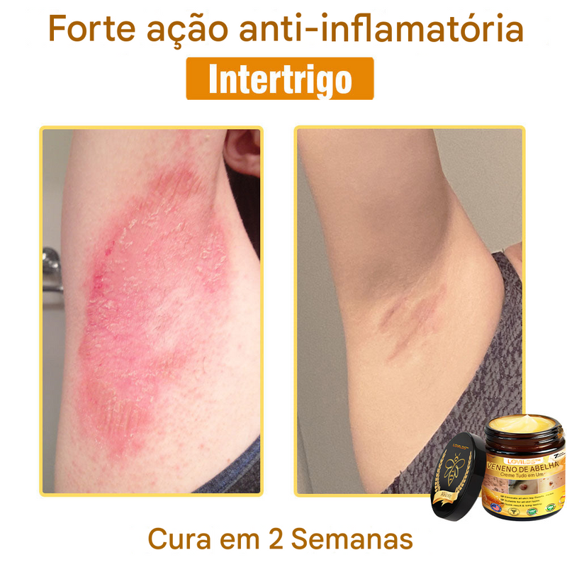 (Compre 1 Leve 2)🔥 LOVILDS™ Creme Multifuncional com Veneno de Abelha 👩‍⚕️Aprovado por Dermatologistas ✅