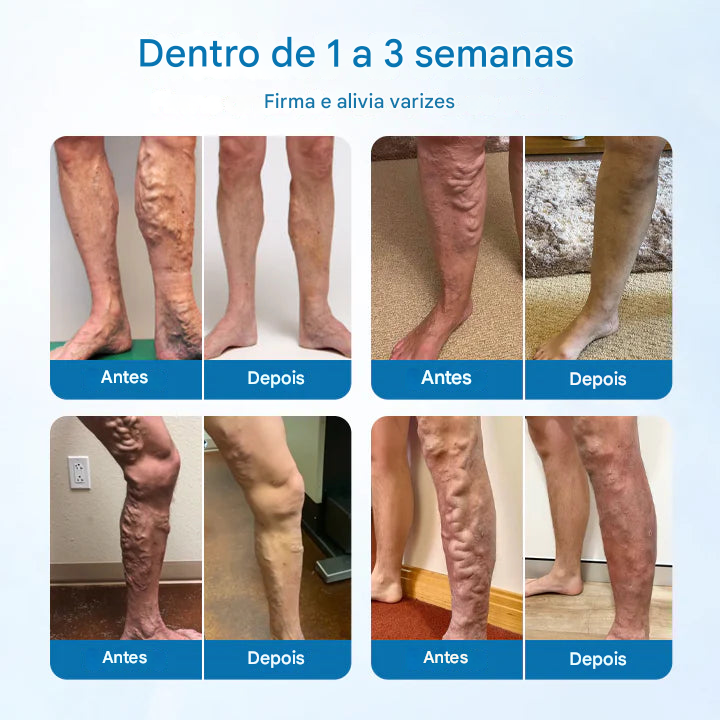 (Compre 1 Leve 2) Spray de ervas Timilk® VeinGuard - ✅ Clinicamente comprovado que elimina varizes em apenas 7 dias!