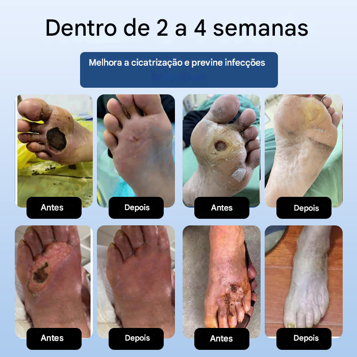DiabeHeal™ Creme de Cicatrização da Pele para Diabéticos