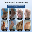 DiabeHeal™ Creme de Cicatrização da Pele para Diabéticos