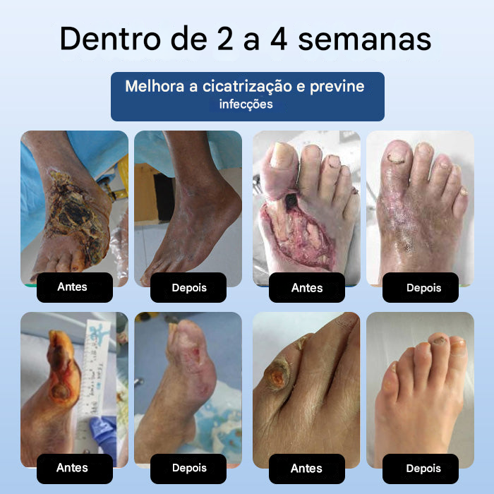 DiabeHeal™ Creme de Cicatrização da Pele para Diabéticos