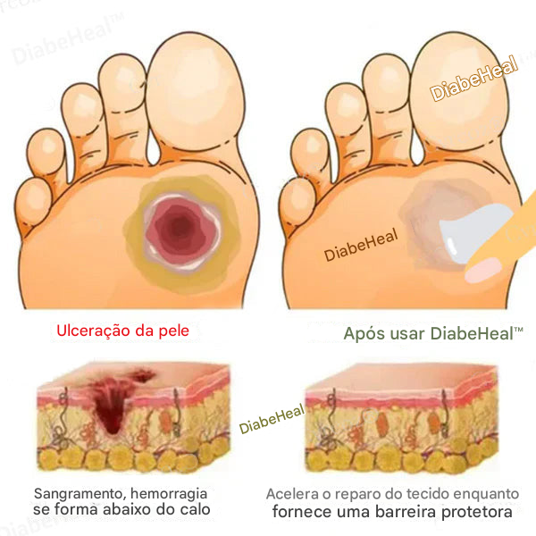 DiabeHeal™ Creme de Cicatrização da Pele para Diabéticos