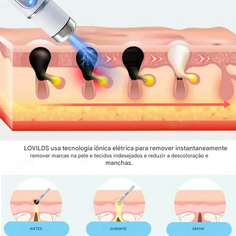 (Compre 1 LEVE 2)🔥 Caneta a Laser LOVILDS™ para Remoção de Sinais e Verrugas Sem Cirurgia ✅