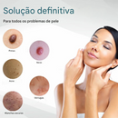 (Compre 1 LEVE 2)🔥 Caneta a Laser LOVILDS™ para Remoção de Sinais e Verrugas Sem Cirurgia ✅