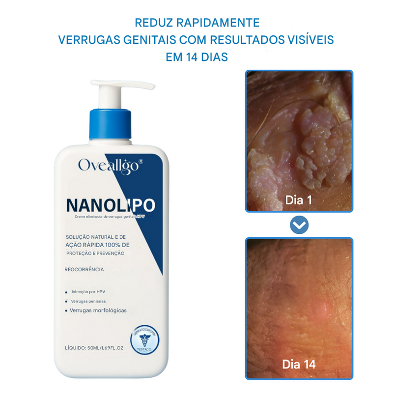 Oveallgo® NanoLipo Creme Removedor de Verrugas Genitais HPV
