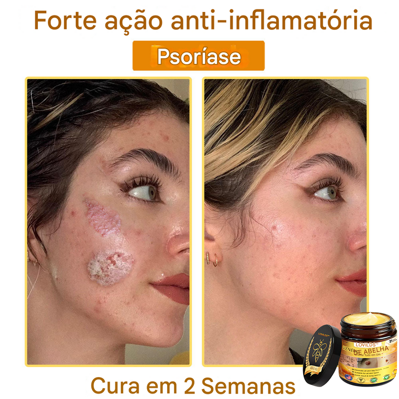 (Compre 1 Leve 2)🔥 LOVILDS™ Creme Multifuncional com Veneno de Abelha 👩‍⚕️Aprovado por Dermatologistas ✅