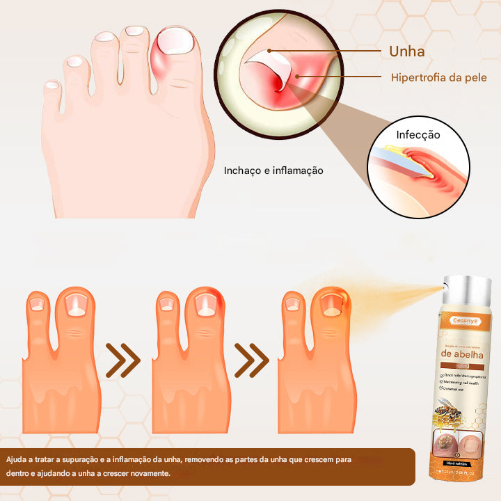 Ceoerty® Resgate das Unhas Spray de Veneno de Abelha