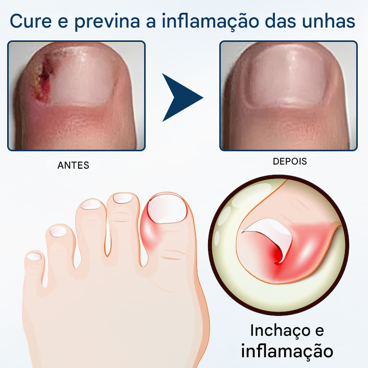 (Compre 1 Leve 2)🔥 Spray de ervas para reparação de fungos Timilk® OnyxiGuard