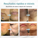 (Compre 1 LEVE 2)🔥 Caneta a Laser LOVILDS™ para Remoção de Sinais e Verrugas Sem Cirurgia ✅