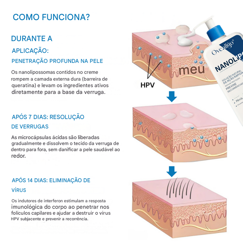 Oveallgo® NanoLipo Creme Removedor de Verrugas Genitais HPV