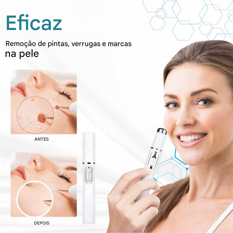(Compre 1 LEVE 2)🔥 Caneta a Laser LOVILDS™ para Remoção de Sinais e Verrugas Sem Cirurgia ✅