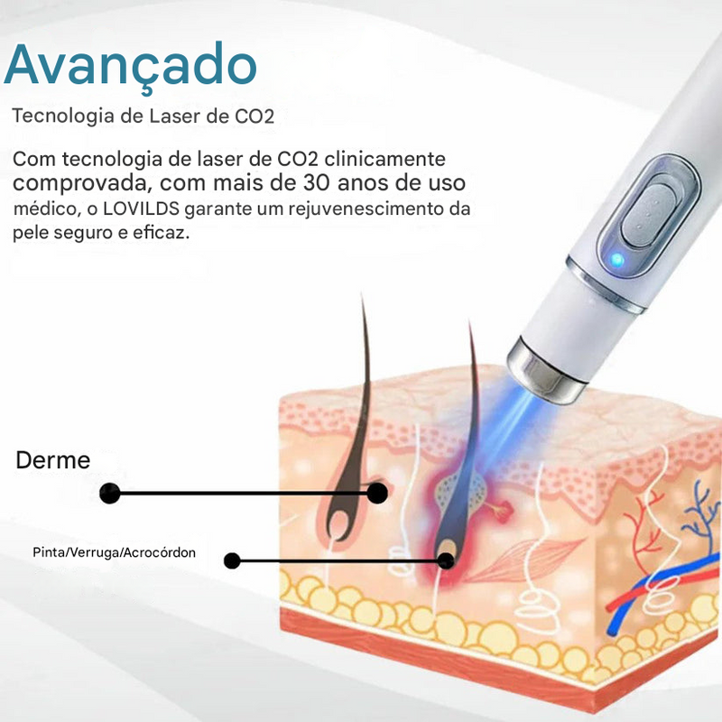(Compre 1 LEVE 2)🔥 Caneta a Laser LOVILDS™ para Remoção de Sinais e Verrugas Sem Cirurgia ✅